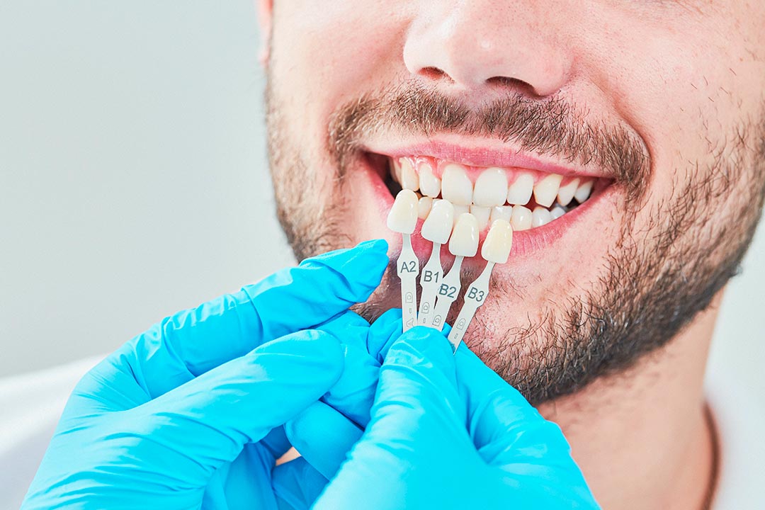 Eine Auswahl an Veneers mit unterschiedlichen Farbnuancen wird an die Zähne eines Patienten gehalten.