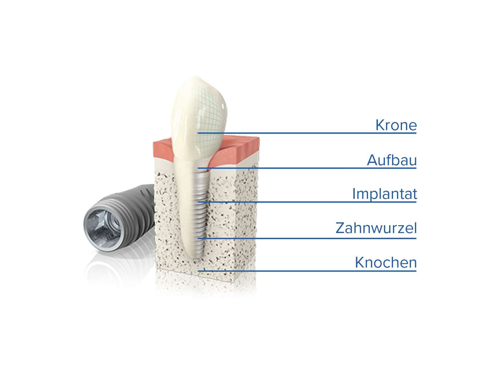 Einsatz eines Zahn-Implantats von unten nach oben: Knochen, Zahnwurzel, Implantat, Aufbau, Krone